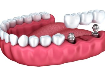 การเตรียมตัวเมื่อจะไปครอบฟันและทำสะพานฟัน