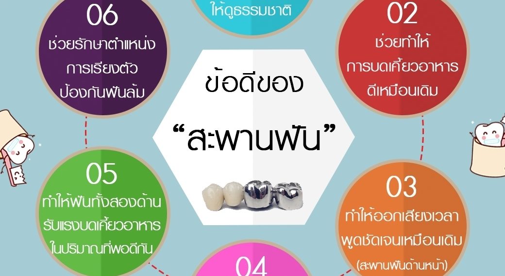 ข้อดีของสะพานฟัน