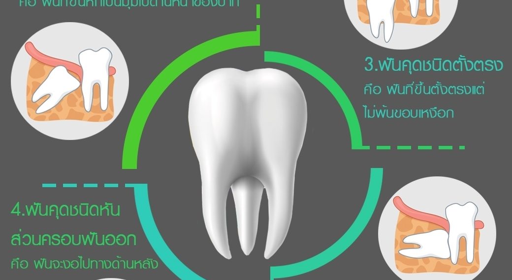 ฟันคุด มีกี่แบบ??