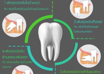 ฟันคุด มีกี่แบบ??