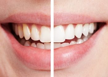 ฟันของคุณเฉดสีไหน แล้วจำเป็นต้องฟอกสีฟันรึยัง